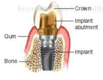 Implants