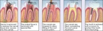 Root Canal Therapies